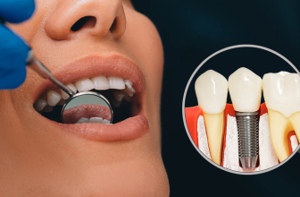 Mantenimiento de los implantes dentales: limpieza y revisiones necesarias