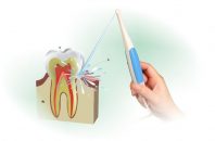 Los 7 mejores irrigadores dentales